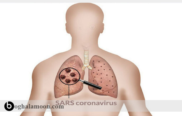 بیماری های ویروسی قابل انتقال از حیوان به انسان:سندرم حاد تنفسي (سارس،کرونا)