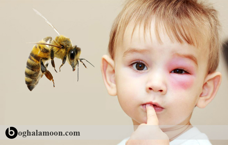 ناسازگاری (آلرژی) نسبت به زهر زنبور عسل